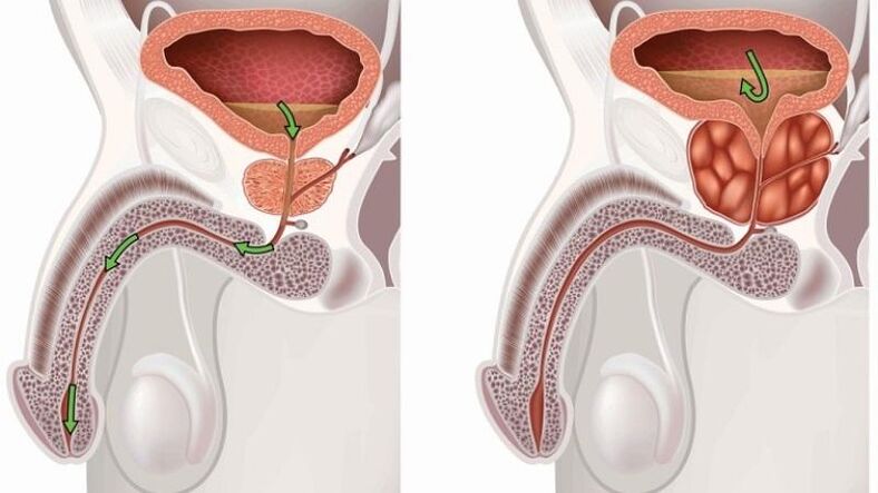stagnacija urina zaradi prostatitisa