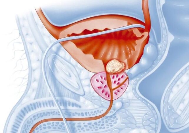 Značilnosti kroničnega prostatitisa